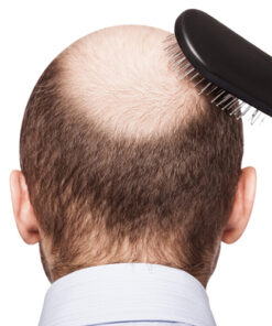 Tratamiento de alopecia